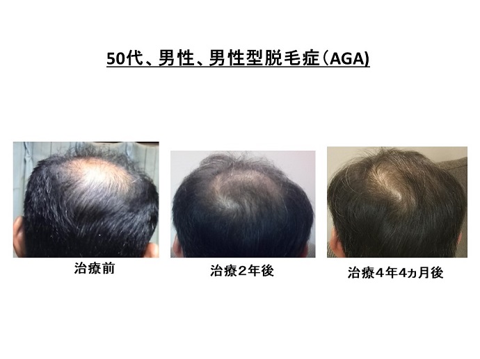 円形脱毛症　病院